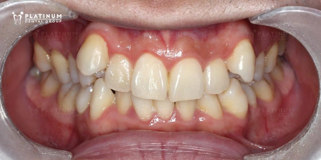 Hàm răng trước khi điều trị niềng răng của Khánh với khá nhiều khấp khểnh (hướng chính diện)