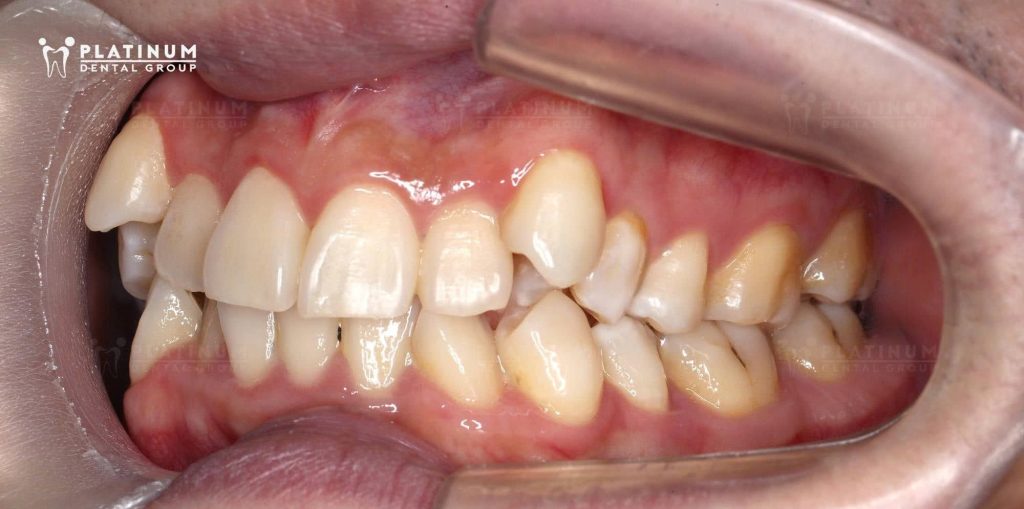 Hàm răng trước khi điều trị niềng răng của Khánh với khá nhiều khấp khểnh (hướng nghiêng)