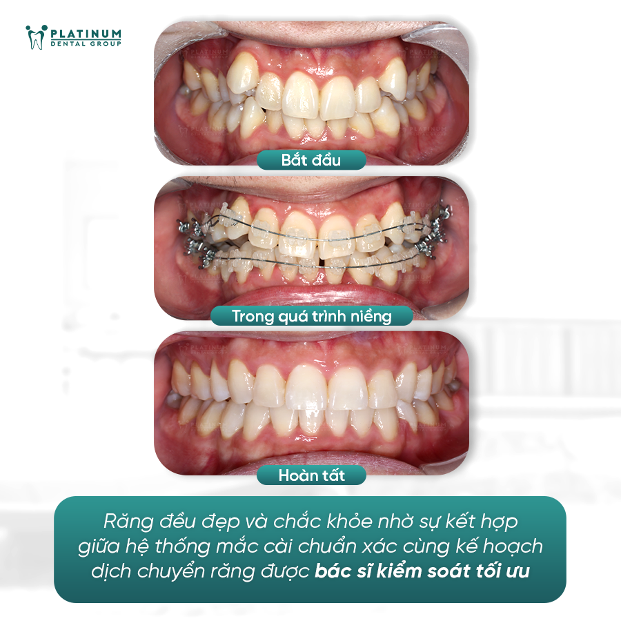 KẾ HOẠCH ĐIỀU TRỊ: SẮP XẾP RĂNG VỀ ĐÚNG VỊ TRÍ