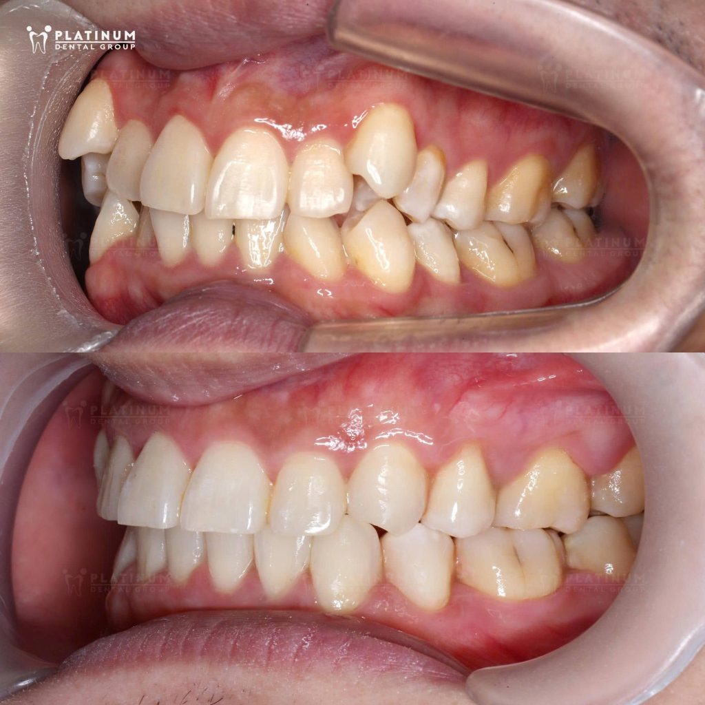 hình ảnh trước và sau khi Khánh Ngô niềng răng