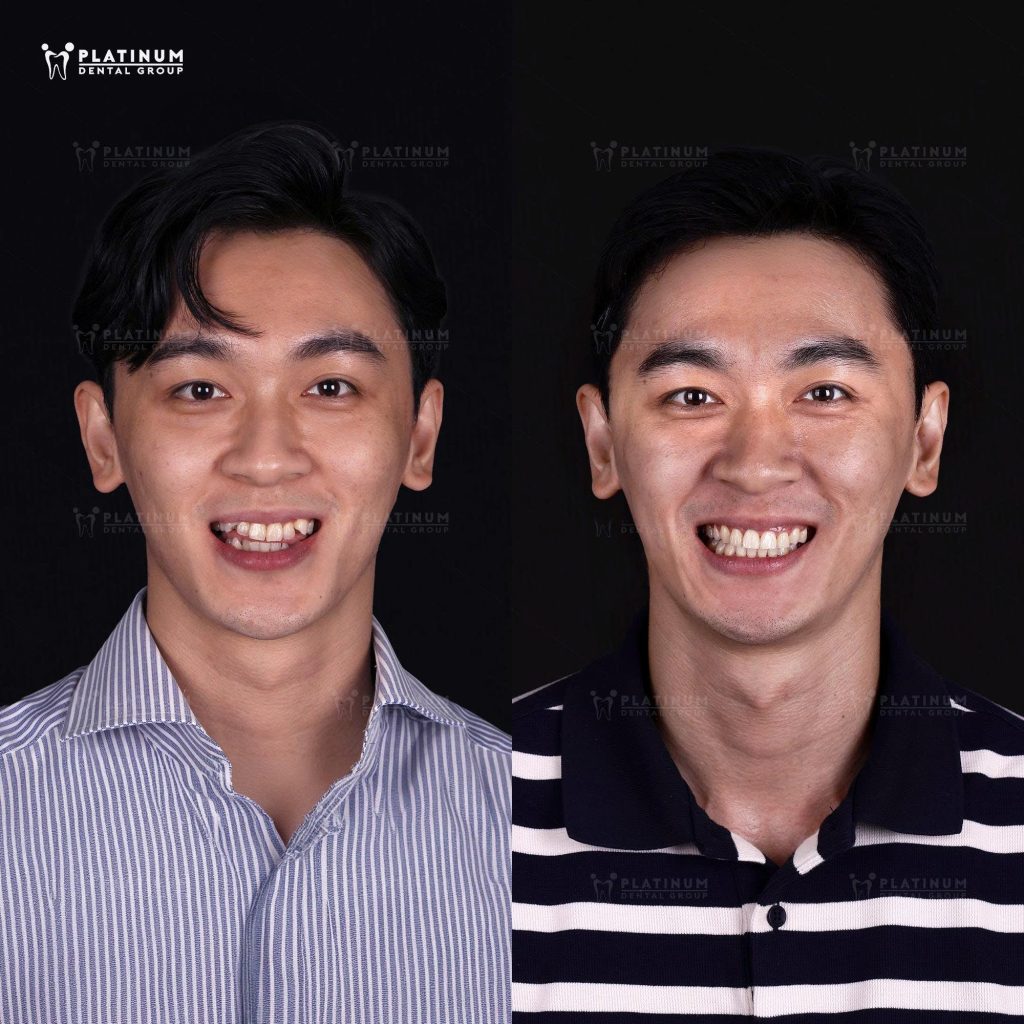 hình ảnh trước và sau khi Khánh Ngô niềng răng