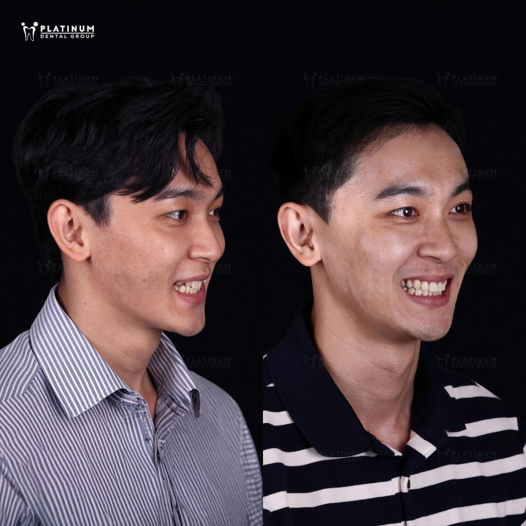 hình ảnh trước và sau khi Khánh Ngô niềng răng (góc nghiêng)