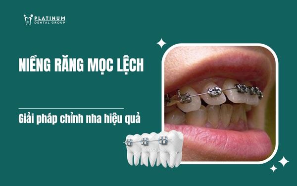 niềng răng mọc lệch