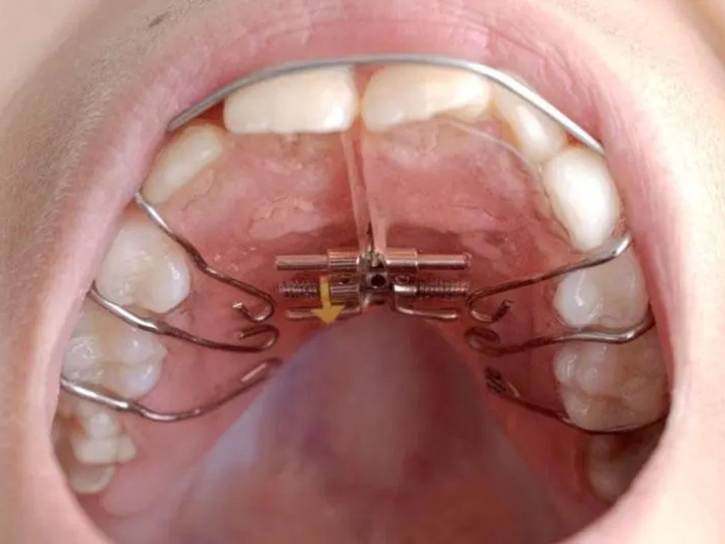 Niềng răng tháo lắp kim loại là loại khí cụ truyền thống