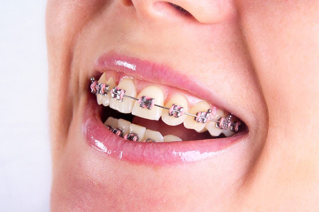 Niềng răng phù hợp với những trường hợp hàm lệch nhẹ đến trung bình