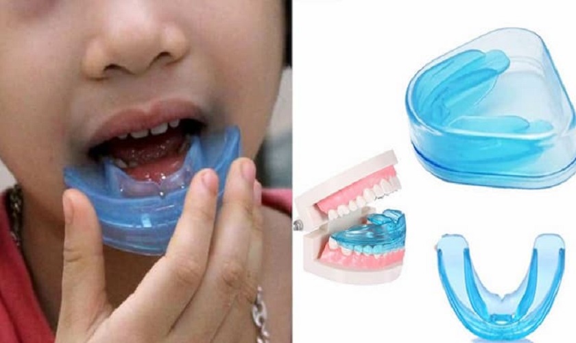 Quảng cáo “niềng răng tại nhà” đánh vào tâm lý nhanh - rẻ - tiện nhưng tiềm ẩn nhiều rủi ro