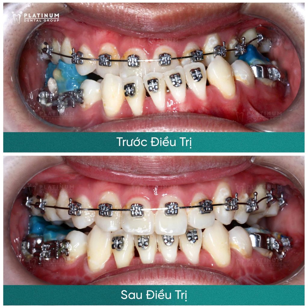 Tìm hiểu răng đã lấy tủy có niềng được không? 3 Niềng răng còn là cách để bảo vệ sức khỏe răng miệng lâu dài, tránh bị sâu răng dẫn đến hư tủy răng