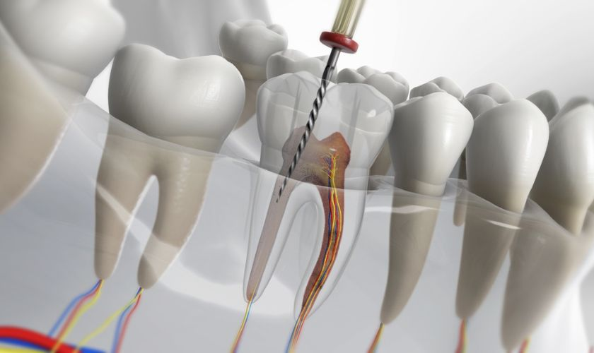 Tìm hiểu răng đã lấy tủy có niềng được không? 4 Niềng răng cho răng đã lấy tủy nhìn chung không nguy hiểm nếu được thực hiện đúng kỹ thuật