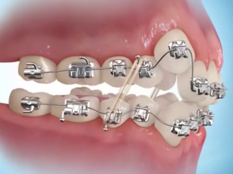 Giải đáp: Niềng răng có mất răng khểnh không? 3 Răng khểnh vẫn có thể giữ lại và điều chỉnh thẳng hàng