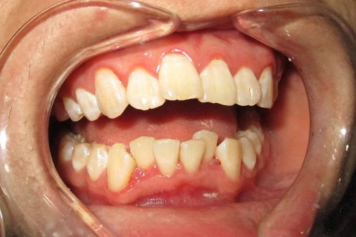 Răng lệch có thể làm thay đổi thẩm mỹ gương mặt và ảnh hưởng chức năng ăn nhai