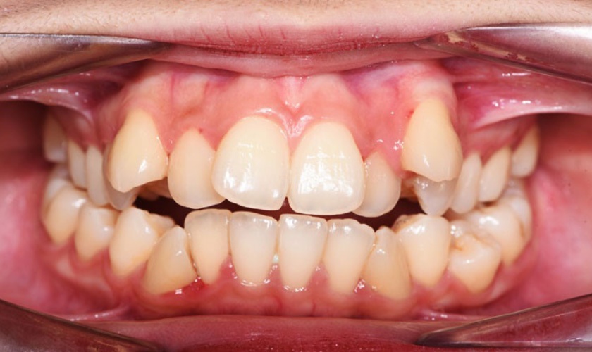 Răng mọc lệch khấp khểnh, chen chúc trên cung hàm
