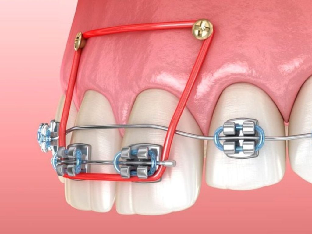 Vít niềng răng là một trụ nhỏ bằng titanium được cắm tạm thời vào xương hàm